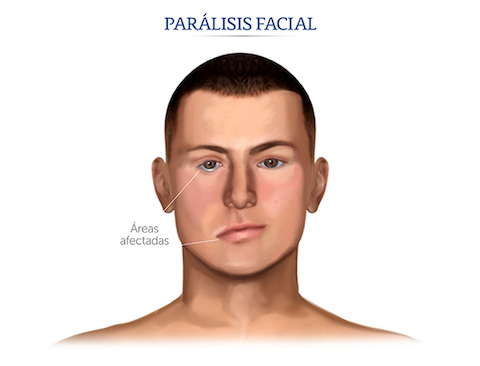 Parálisis Facial